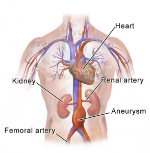 Abdominal_Aortic_Aneurysm_Location